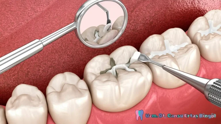 Fissür-Örtücü-Nedir-Nasıl-Uygulanır